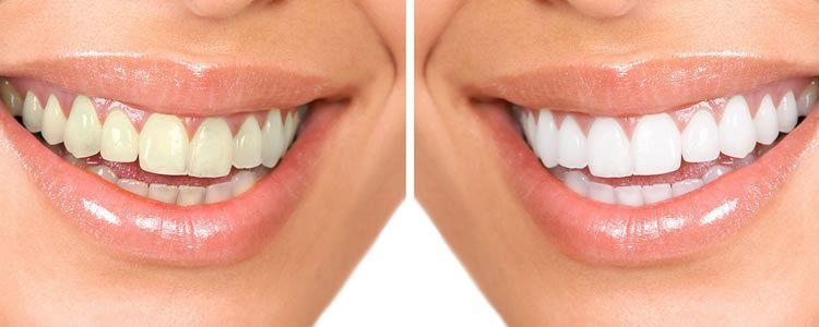 teeth-whitening (1)