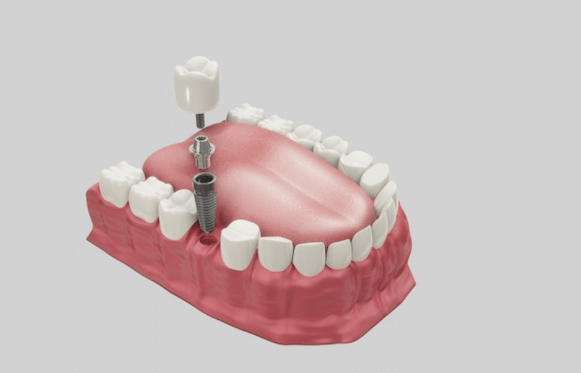 dental implants myth