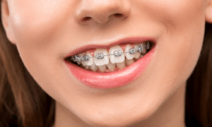 learn about orthodontics braces