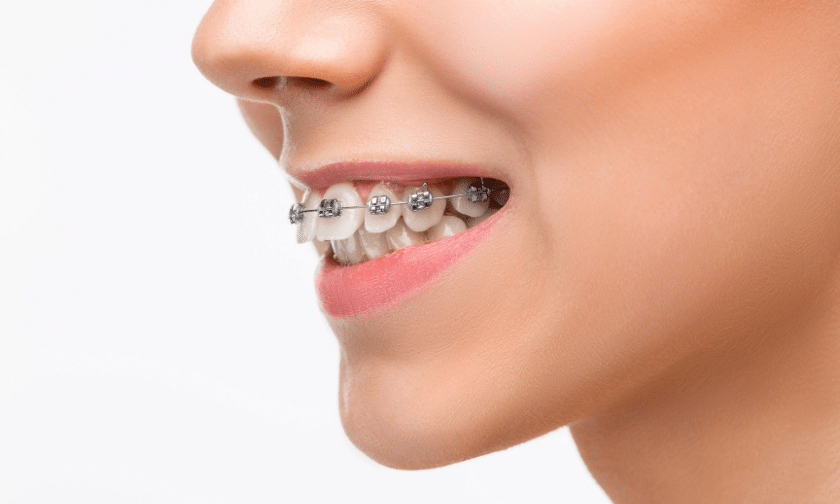 Learn to get the most out of your braces