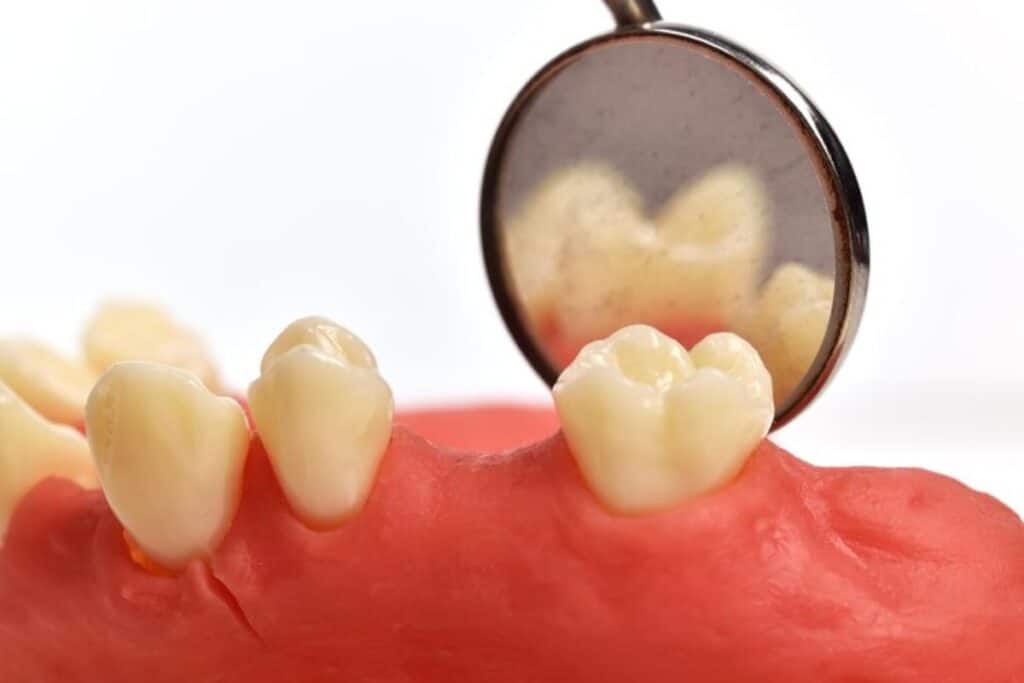 What to Do When a Crown Won’t Stay on My Tooth