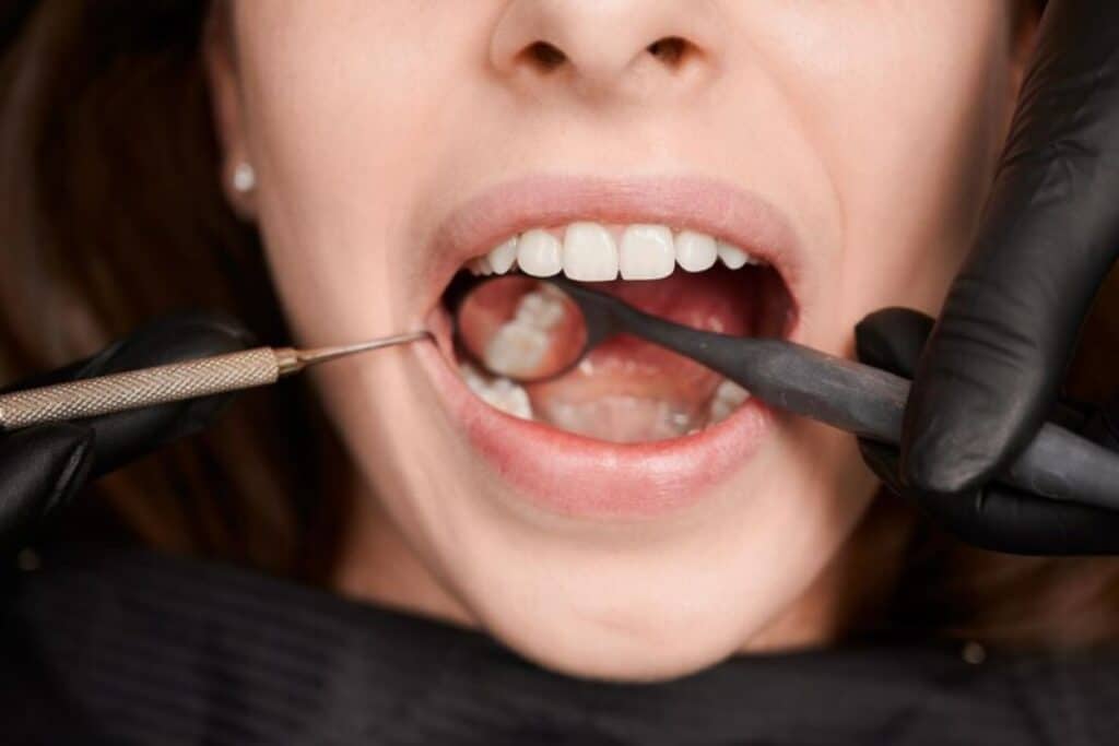 Cavities & Tooth Decay