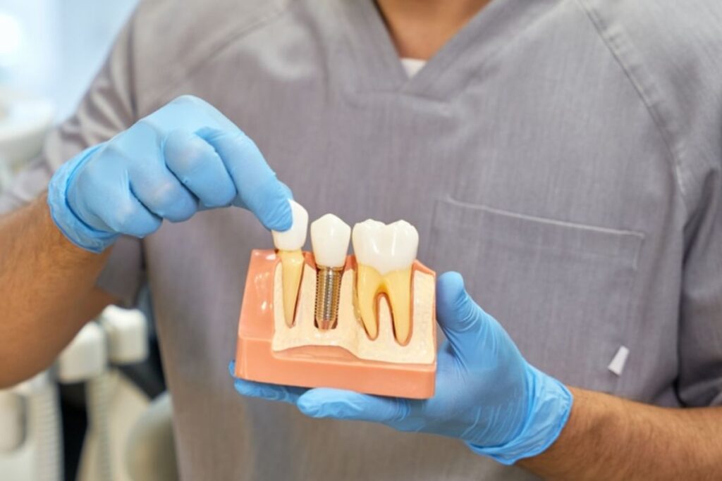 dental implants
