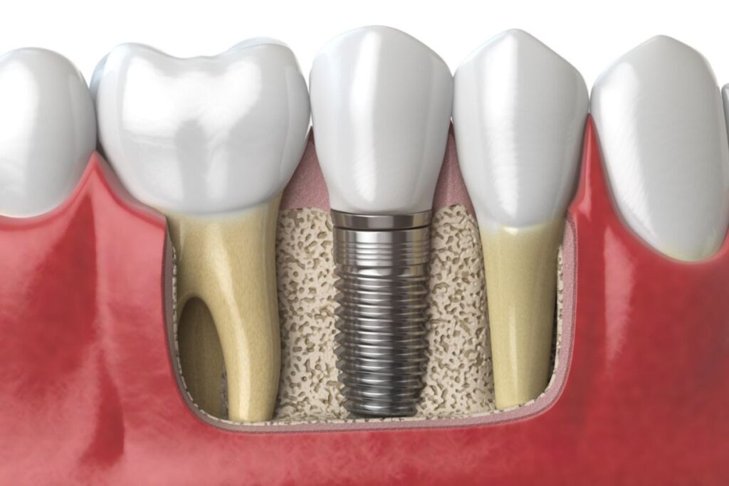 Dental Implant Break Inside the Mouth