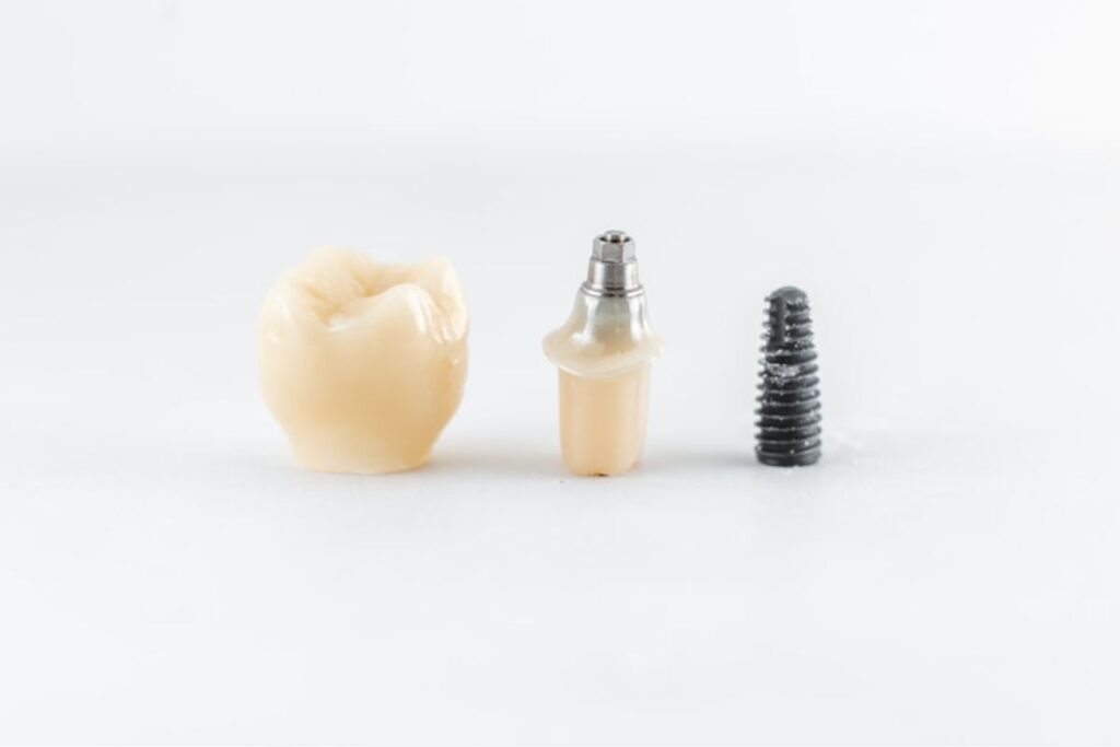 Repair Process for Broken Dental Implants