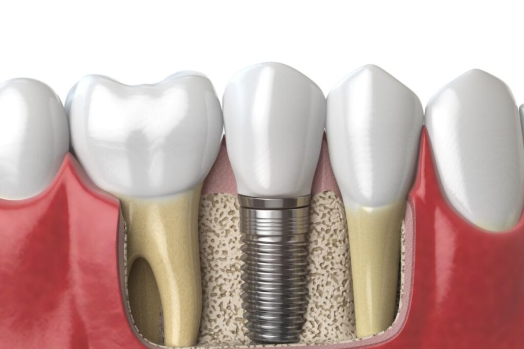 Dental Implants Help Prevent Bone Loss