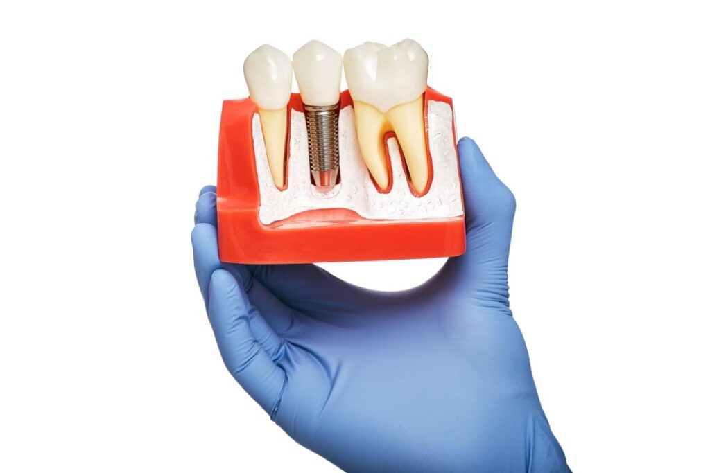 Dental Implants
