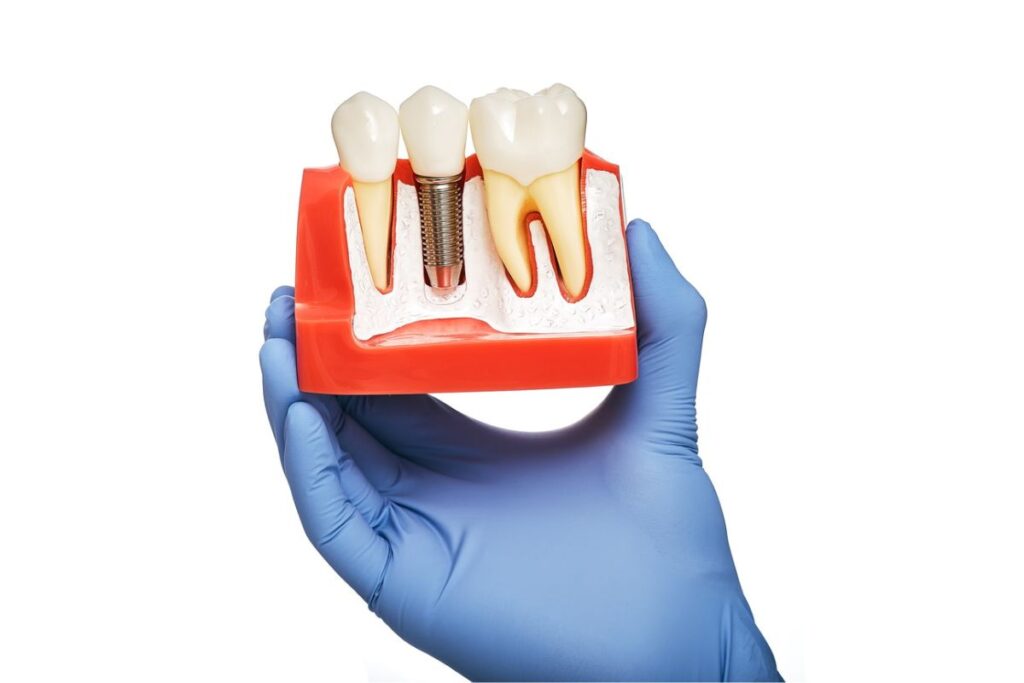 dental implants in twin falls
