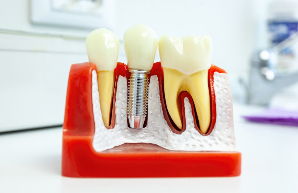 dental implants
