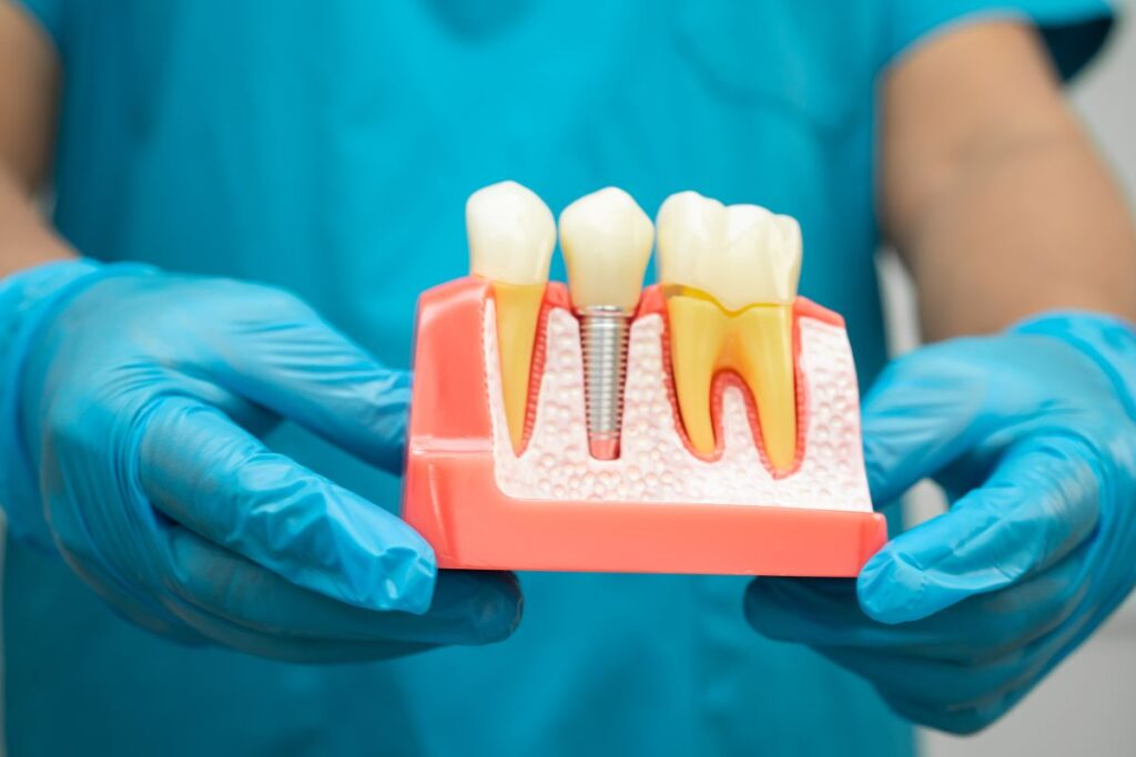 dental implants