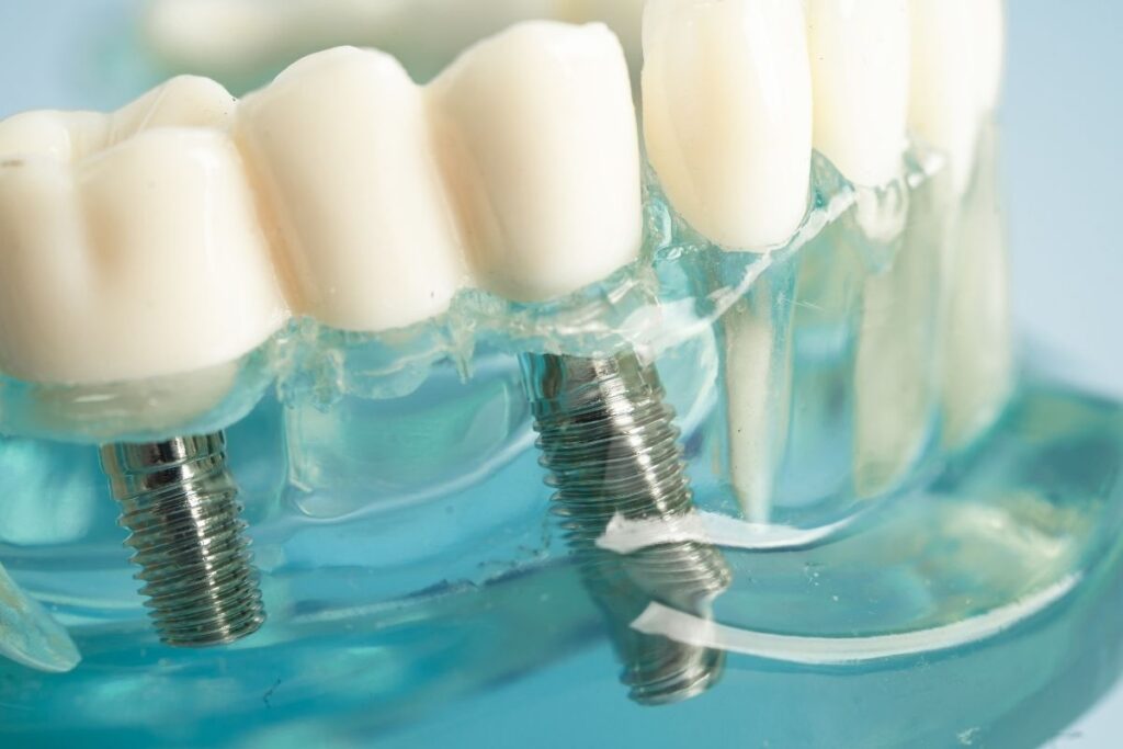 dental implants
