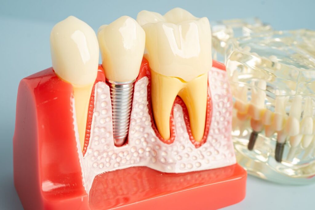 Right Time for Dental Implants