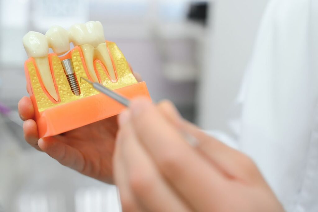 how long do dental implants last